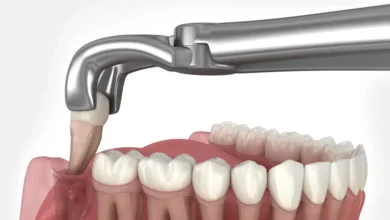 Family Dental Care Understanding Wisdom Tooth Extraction Costs for Parents and Teens in Singapore