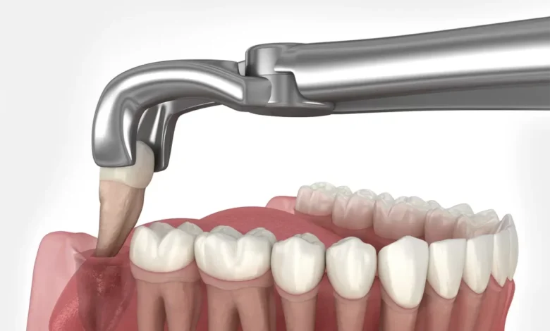 Family Dental Care Understanding Wisdom Tooth Extraction Costs for Parents and Teens in Singapore